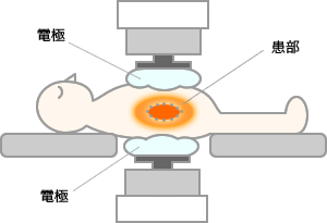 ビオセラクリニック｜局所温熱治療イメージ