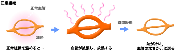 ビオセラクリニック温熱療法　正常細胞とがん組織の血管の違い