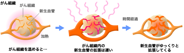 ビオセラクリニック温熱療法　がん組織の新生血管はゆっくりと拡張