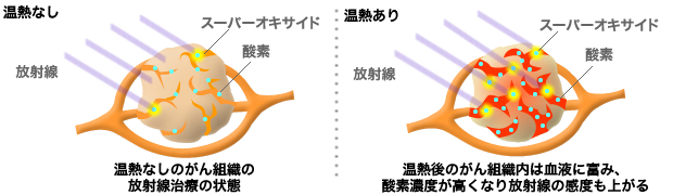 ビオセラクリニック温熱療法　温熱療法後の放射線治療が効果的な理由